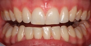 close up photo of straight teeth after invisalign treatment