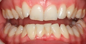 close up pitcture of crooked teeth