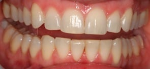 close up photo of straight teeth upper and lower teeth after invisalign treatment