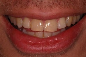 straight front teeth after invisalign braces