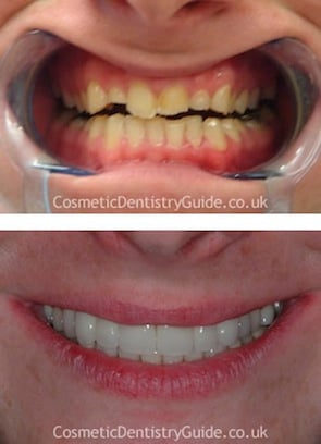 veneers dental porcelain makeovers smile mulberry riten patel donated dr cosmetic