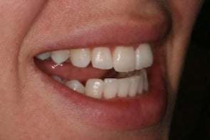 after inman aligner treatment lower straight teeth