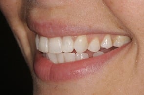 after inman aligner treatment