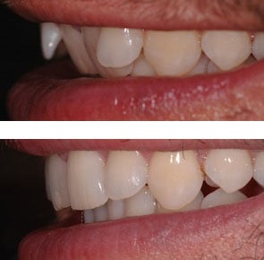 before and after inman aligner treatment in london